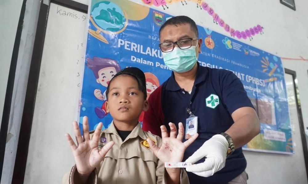 Targetkan Zero Frambusia, Dinkes Batang Skrining dan Edukasi Seluruh Anak