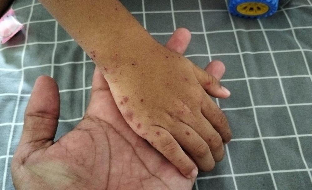 Flu Singapura Merebak di Batang, Ringan Namun Menular